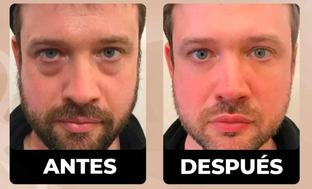 Antes y después — ojeras
