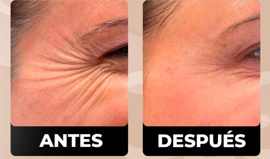 Antes y después — patas de gallo
