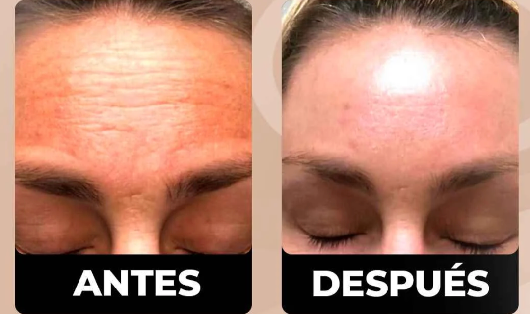 Antes y después — líneas